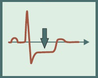 ECG criteria, ST depression NSTEMI (Non ST elevation Myocardial infarction)