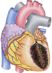 Hyperacute anterior STEMI infarction