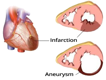 Left ventricular aneurysm, persistent ST elevation (convex, concave upwards)