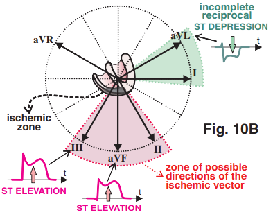 Inferior STEMI infarction, reciprocal ST depression, ischemic vector