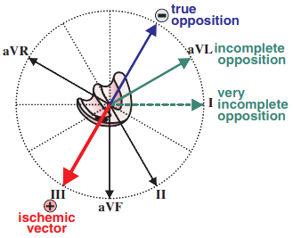 STEMI ST elevation infarction, reciprocal changes, ischemic vector, true opposition vector, incomplete opposition ECG lead
