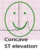 Concave ST segment elevation, acute STEMI infarction