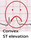 Convex (non-concave) ST segment elevation, acute STEMI infarction