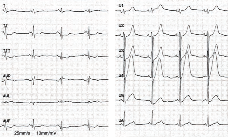 ECG hyperacute STEMI infarction, hyperacute T waves