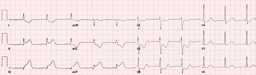 ECG acute (minutes - hours) inferor STEMI infarction, occlusion RCA or LCx, 