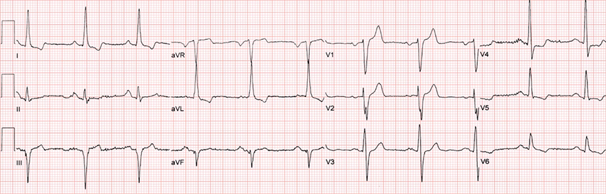 ECG old (weeks - years) posterior STEMI infarction, occlusion RCA or LCx