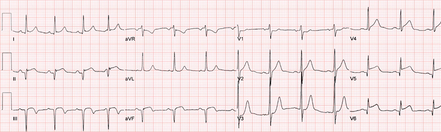 ECG old (weeks - years) inferior and lateral wall STEMI infarction, occlusion LCx