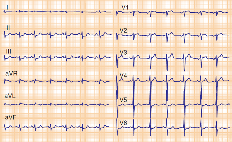 ECG acute occlusion LAD, pseudonormalization T wave, hyperacute anterior STEMI
