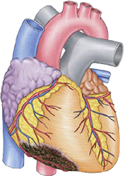 Old inferior wall STEMI infarction, occlusion LCx or RCA artery - culprit artery