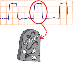Tombstoning ST elevation MI, Pardee curve wave STEMI infarction