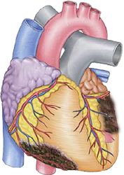 Subacute STEMI infarction inferior and lateral wall, occlusion LCx artery - culprit artery