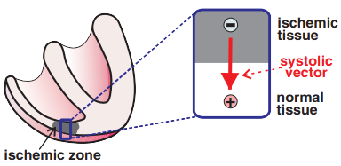 Inferior STEMI infarction, ischemic vector, ST elevation in inferior leads (II, III, aVF)