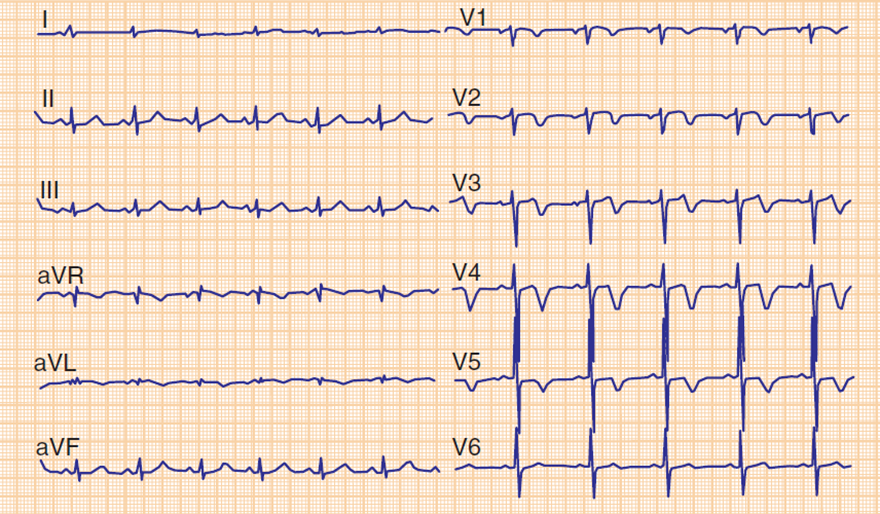 ECG unstable angina pectoris, stenosis proximal left anterior descending artery