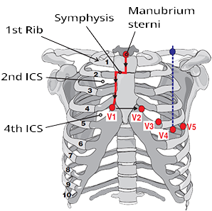 Correct position of the precordial electrodes, diagnosis anteroseptal myocardial infarction, left anterior hemiblock (LAF)