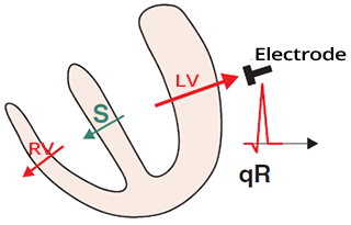 Normal septal Q wave, septum depolarization