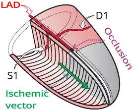 Distal LAD occlusion of first septal branch (S1), distal of first diagonal branch (D1)