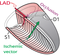 Left anterior descending artery (LAD) occlusion proximal DI, and distal S1