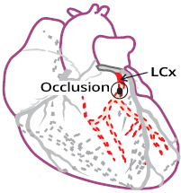 Inferior posterior lateral STEMI due to RCx occlusion