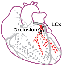 Isolated high lateral STEMI infarction, proximal occlusion non-dominant ramus circumflexus