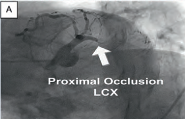 Coronary angiogram proximal occlusion left circumflex artery (LCx)
