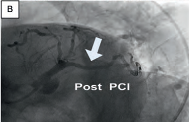 Coronary angiogram after percutaneous coronary intervention (PCI) and stenting