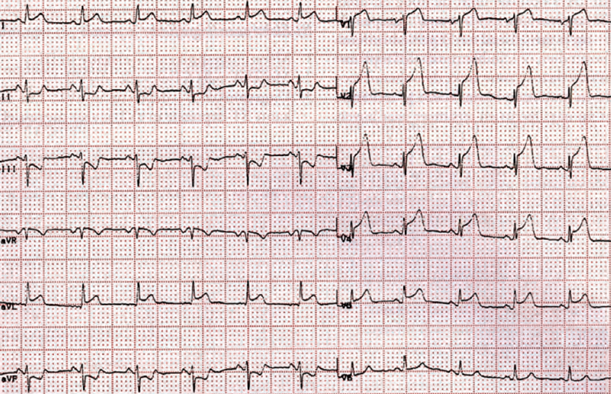 ECG antero-lateral STEMI infarction, ST elevation (V2-V5, I, aVL), reciprocal ST depression (II, III, aVL), culprit artery - vessel: LAD between S1 and D1