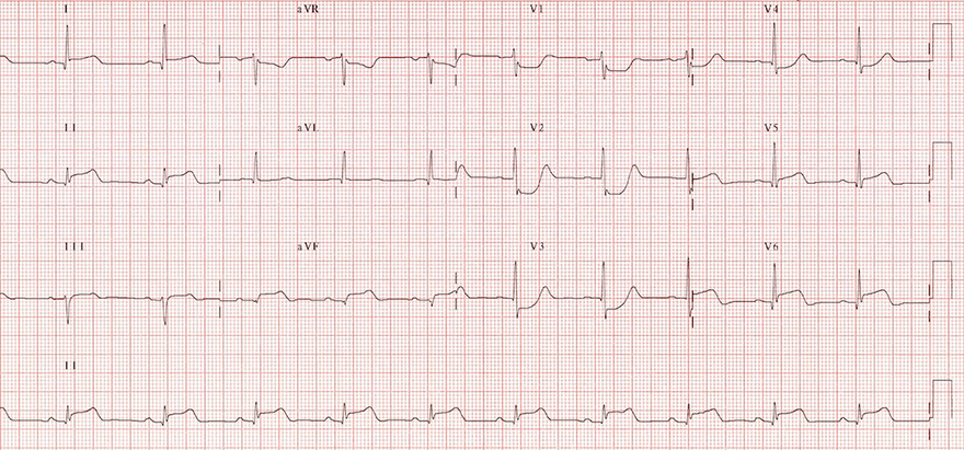 ECG acute infero-postero-lateral STEMI infarction