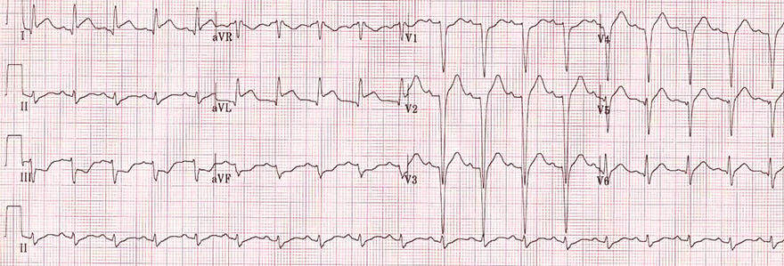 ECG isolated high lateral STEMI infarction, ST elevation (I, aVL), reciprocal ST depression (V1-V3), culprit vessel - first diagonal branch (D1) of LAD