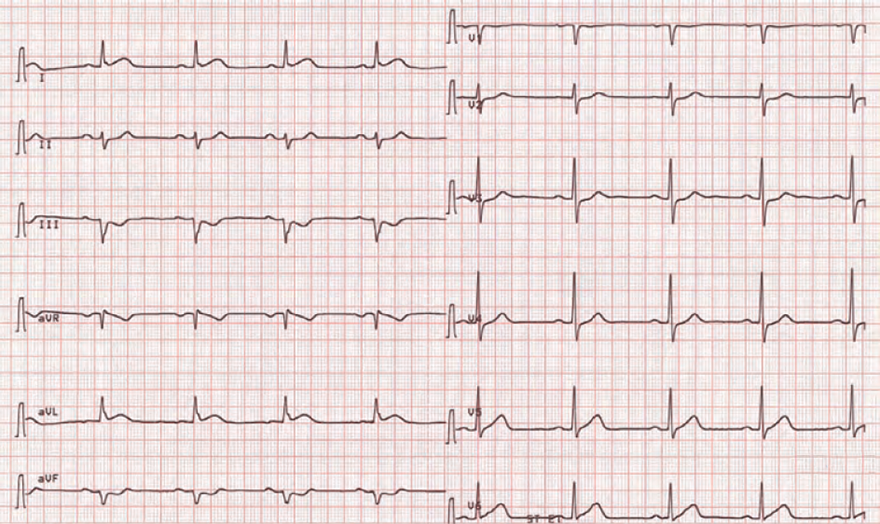 ECG acute isolated lateral STEMI infarction, ST elevation (I, aVL), reciprocal ST depression (III, aVF), sinus bradycardia