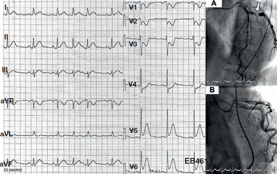 ECG acute postero-lateral STEMI infarction, ST elevation (V5-V6), ST depression (V1-V3)