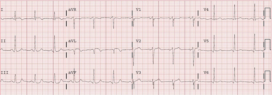 ECG subacute high lateral STEMI infarction, ST elevation (I, aVL), pathological Q wave (aVL)