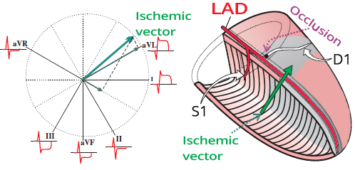 ECG and electrical vector, isolated lateral STEMI, D1 occlusion