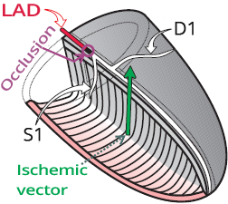 Left anterior descending artery (LAD) occlusion proximal 1st septal (S1) and first diagonal (D1) branch