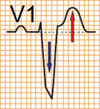 ECG criteria V1 left bundle branch block (LBBB) and STEMI infarction