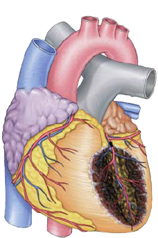 Arrhythmias in acute anterior STEMI infarction