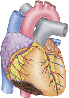 Arrhythmias in acute myocardial infarction, Inferior STEMI
