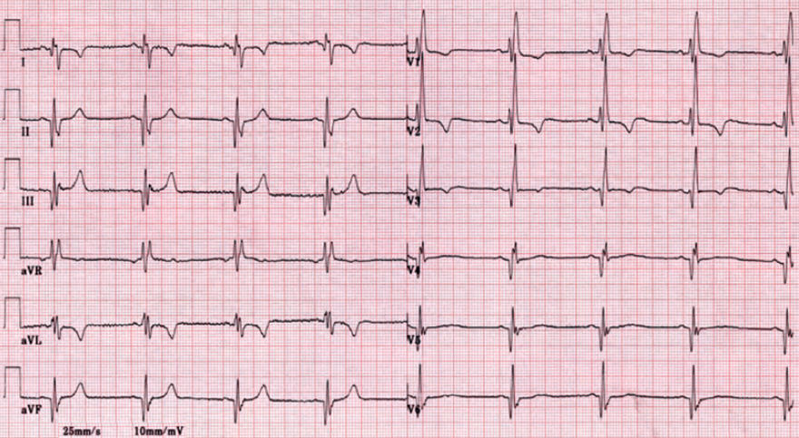 ECG right bundle branch block, old infero-lateral infarction, old anterior infarction