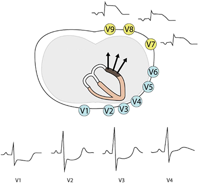 ECG posterior leads (V7-V9), posterior STEMI, Reciprocal changes, ST depression (V1-V4), ST elevation (V7-V9)