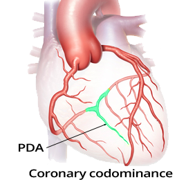 Coronary artery dominance, posterior descending artery (PDA), Co-dominant