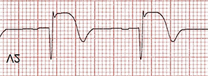 ECG mirror image of posterior STEMI ST elevation