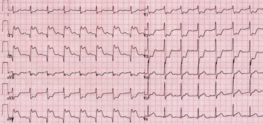 ECG acute posterior and inferior STEMI infarction, ST elevation (II, III, aVF), ST depression (V1-V3)