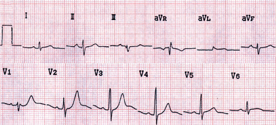 ECG acute posterior myocardial STEMI infarction, ST elevation V6