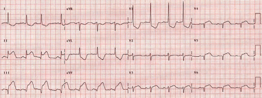 ECG subacute posterior - lateral - inferior myocardia STEMI infarction