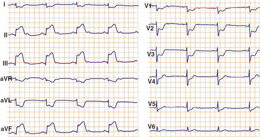 ECG acute infero-postero-right STEMI infarction, pardee curve, sinus rhythm, 2nd degree AV block 2:1 ratio, dominant right artery occlusion - culprit artery
