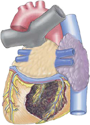 Old posterior STEMI infarction with posterior necrotic window