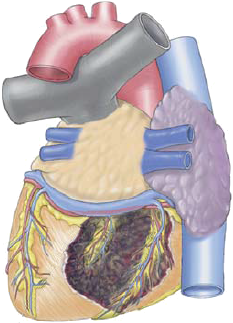 Posterior STEMI infarction localisation, culprit vessel (artery), occlusion left circumflex coronary artery