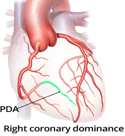 Coronary artery dominance, posterior descending artery (PDA), Right-dominant