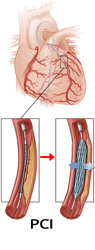 STEMI infarction reperfusion arrhythmias, angioplasty, Resolution ST elevation, accelerated idioventricular rhythm