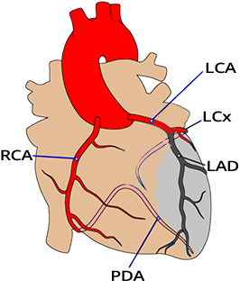 ST elevation in aVR, transmural infarction due to proximal LAD occlusion, basal septum infarction