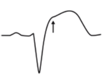 ECG Sgarbossa criteria LBBB and STEMI, discordant ST elevation (V1-V3)